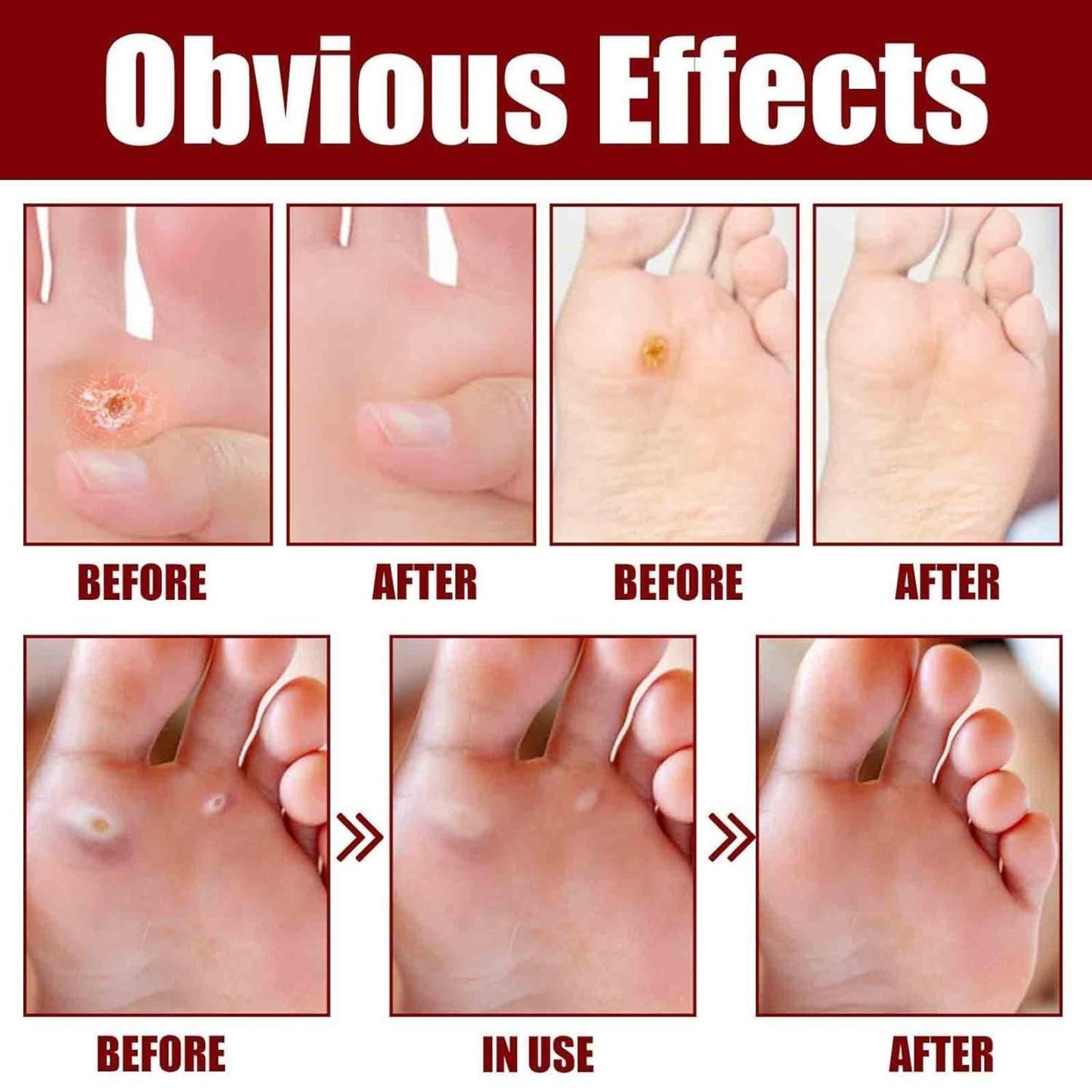 Pain-Free Foot Corn Remover Serum – Fast Action Formula for Corns, Calluses & Cracked Heels